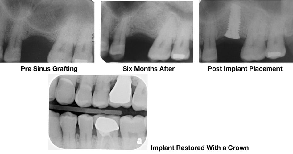 How much pain typically occurs after a tooth implant?