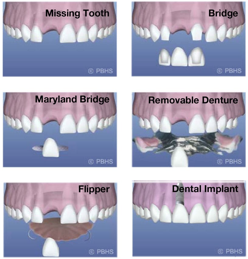 Implants VS Dentures