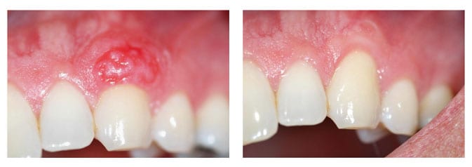Removal of Gingival Pyogenic Granuloma