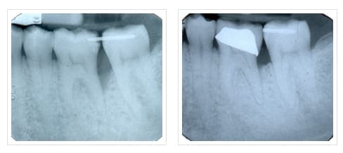 Before Regeneration of Bone Defect & 1 Year After