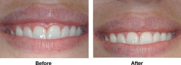 Correction of Gummy Smile of Uneven Gingival Contour