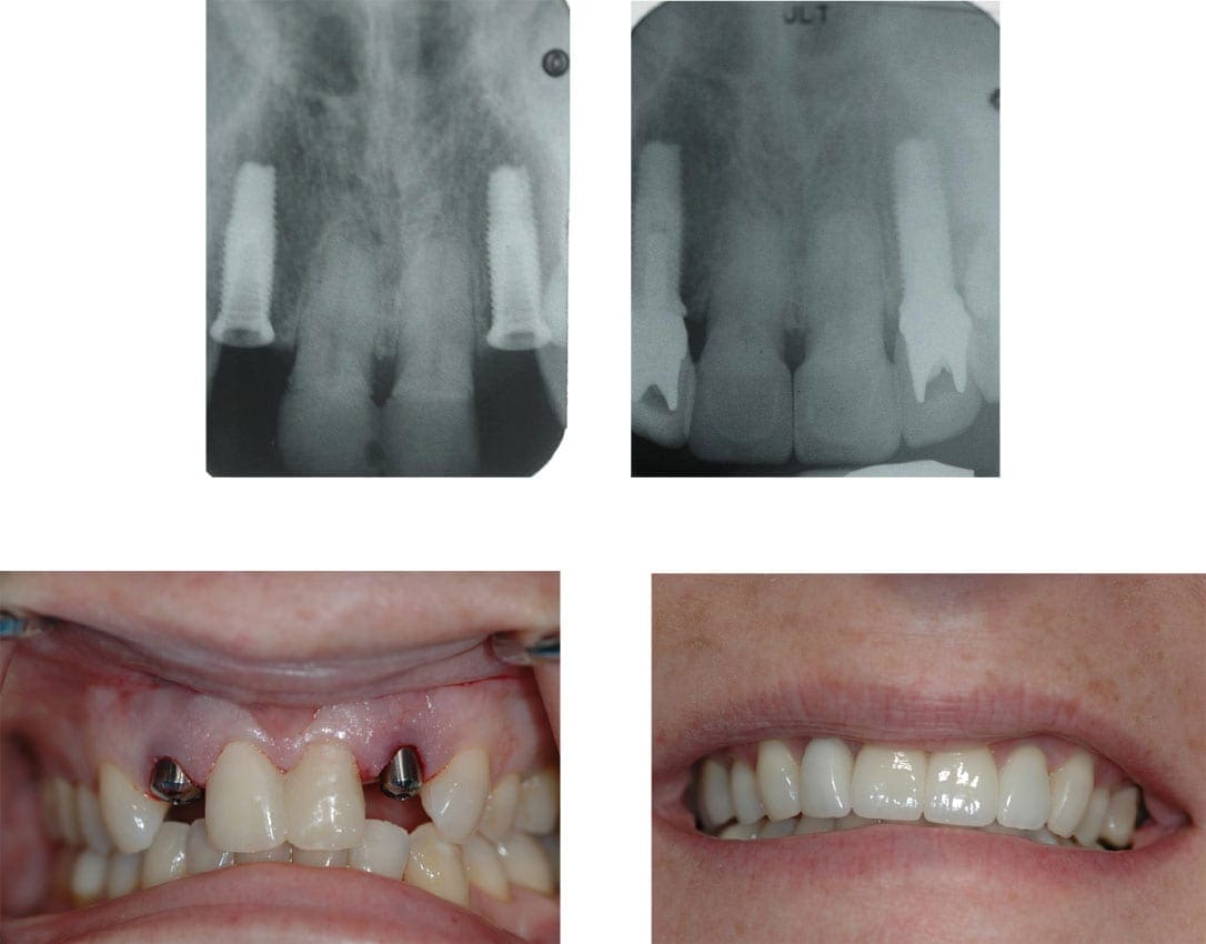 Dental Implants