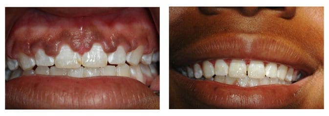 Esthetic Crown Lengthening