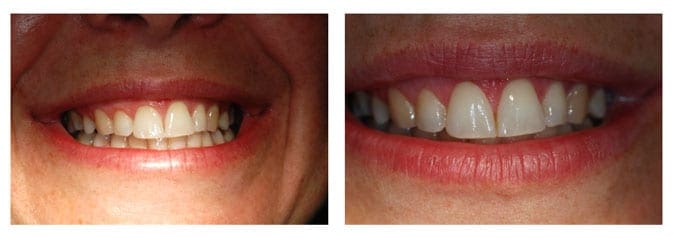 Esthetic Crown Lengthening1