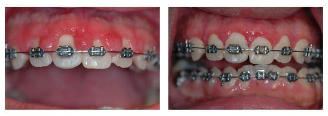 Gingivectomy on 14 year old Girl