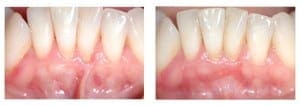 Lower Labial Frenulectomy