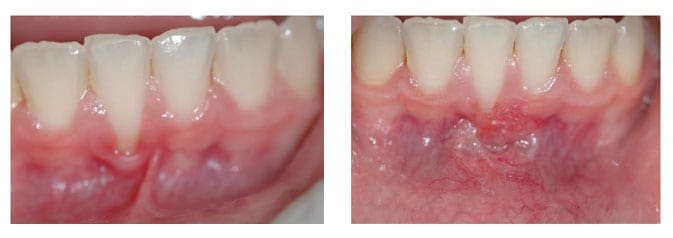 Lower Labial Frenulectomy in a 12 year old child