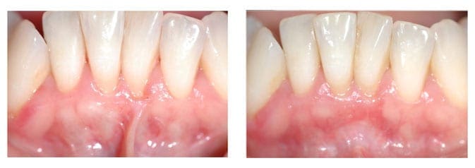 Lower Labial Frenulectomy