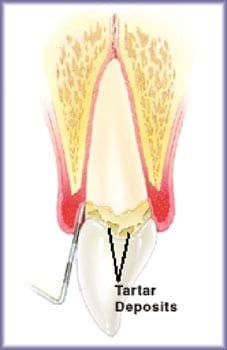 Periodontal Maintenance Periodontal Maintenance