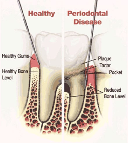 Periodontital-Disease