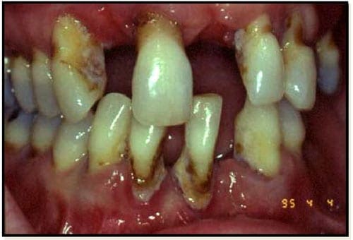 Periodontitis