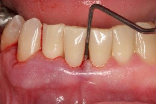 Periodontitis