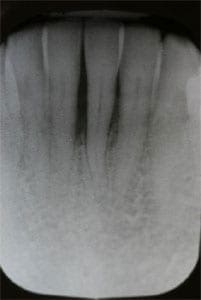 Periodontitis