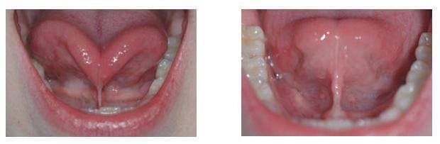 Pre and Post Operative Comparison 2