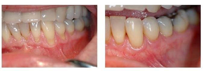 Pre and Post Operative Comparison 