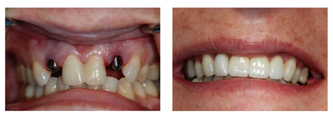 Replacement of upper lateral incisors with immediate dental implants