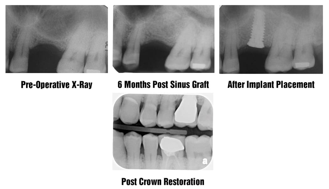 Sinus Augmentation