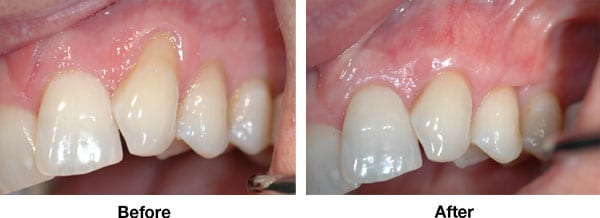 Soft Tissue Grafting for Exposed Roots Gum Recession