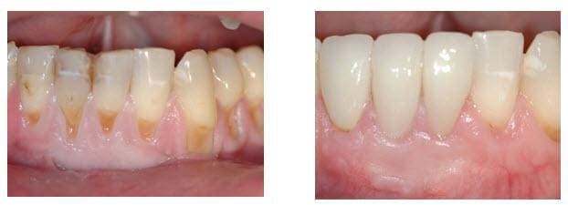 Soft Tissue Grafting