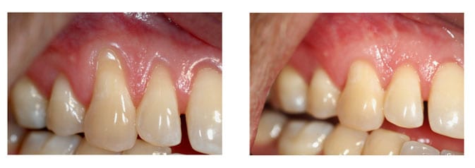 Soft tissue allograft on the upper right canine and lateral incisor