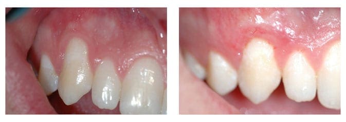 Sub epithelial Connective Tissue Graft of the Upper Right Canine