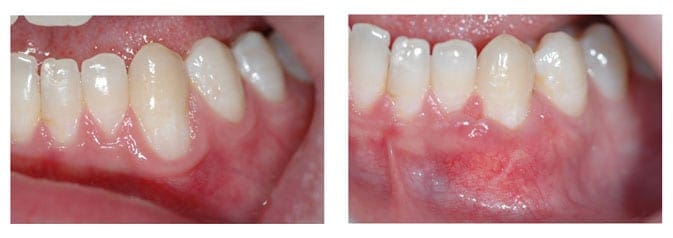 Sub epithelial Connective Tissue Graft of the lower left canine